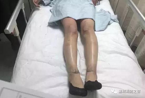 两人怀疑煤气泄漏点火检测 致气罐爆炸双双烧