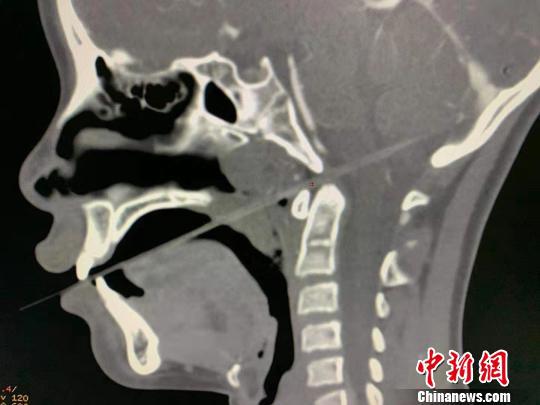 竹签从妞妞的口腔直戳进喉咙,扎进颅内 韩毅 摄