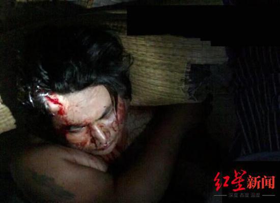 ▲案发后,去诊所包扎伤口的张海宾