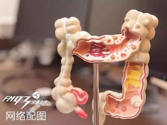 防治直肠癌,不止管住嘴,早期筛查很重要