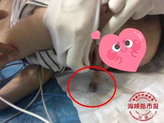 卡住聪聪的龙眼核(画圈处)