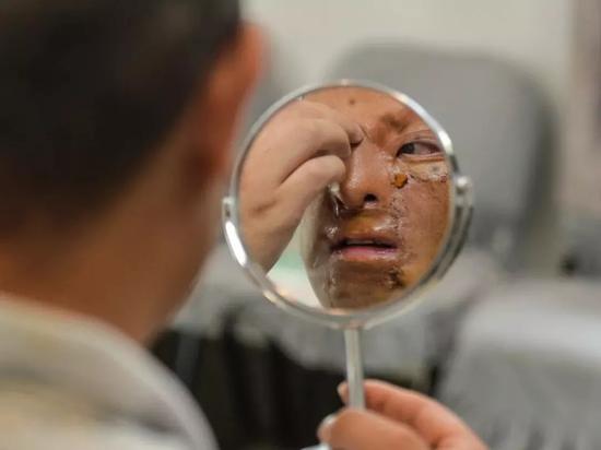 2018年9月11日武汉三医院烧伤科，拆线后的赵雪成照着镜子，亲手感受自己如今的模样。记者 胡冬冬  摄