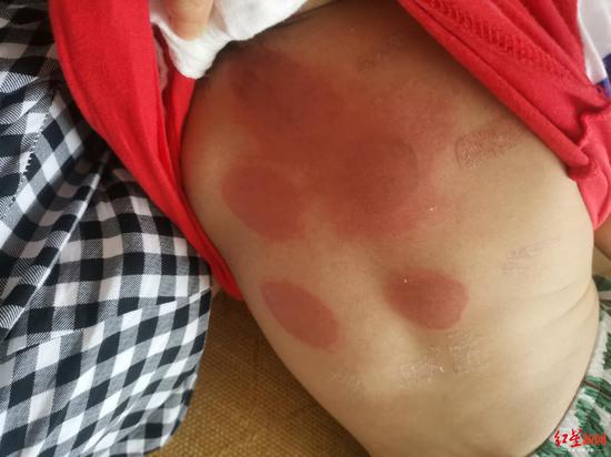 7月12日,吴萌的孩子贴三伏贴后,背部发红