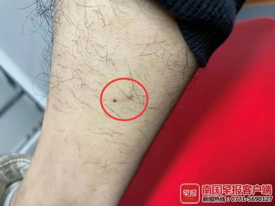 ▲小謝被狗咬傷的部位。