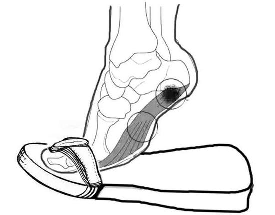 罪魁祸首是“人字拖”?长跑健将差点把自己脚毁了