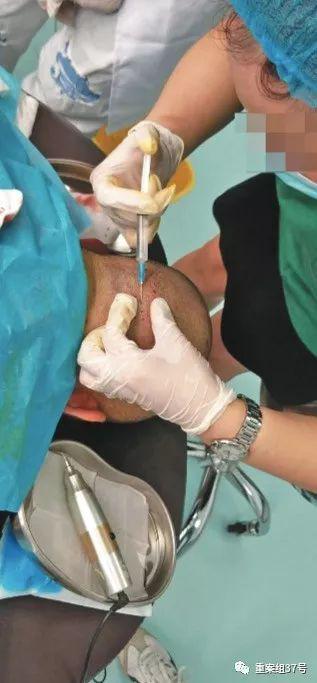 记者卧底“植发3天速成班”:练2小时就给患者手术