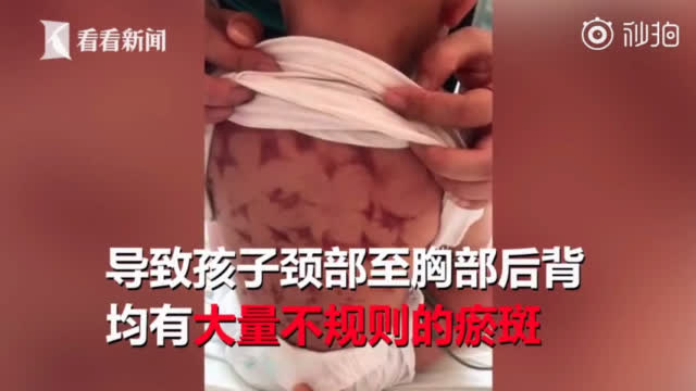 1岁宝宝发烧奶奶信土法用手猛掐 结果整个
