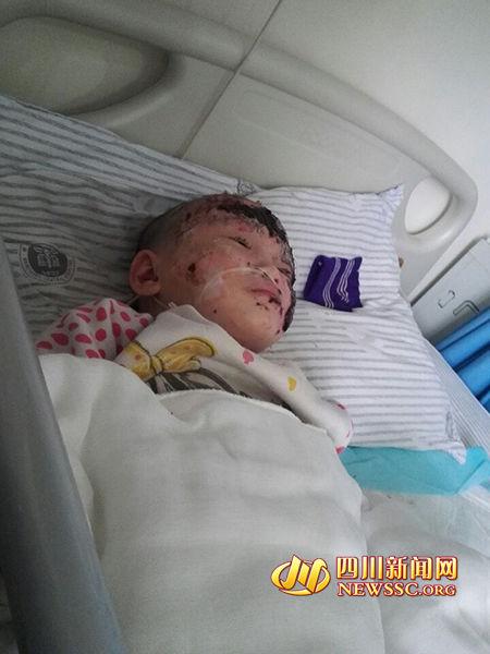 3岁女孩烤火栽进煤炉 大面积烧伤手术费超20万