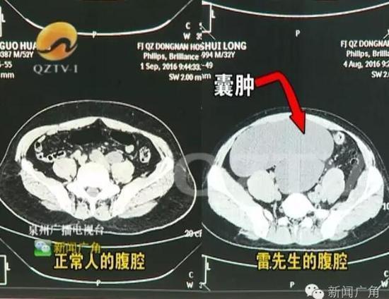 男子腹部隆起似“怀孕” 一查体内居然有4个肾