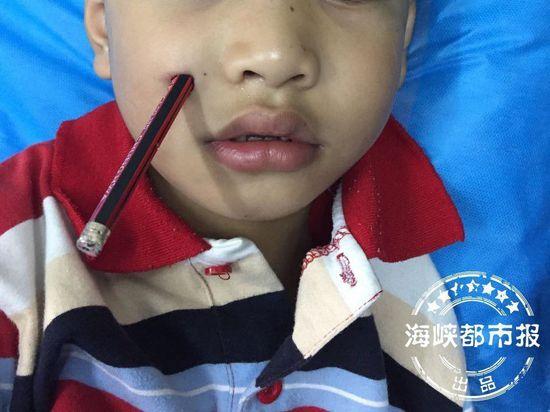 福州1岁男童跌倒 筷子只差5毫米戳爆颅底