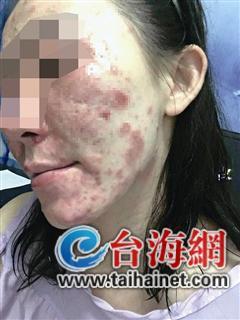 曾女士被诊断为过敏性皮炎