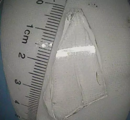 医生紧急救治,顺利将玻璃取出