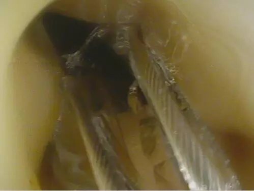 吞下这么大的玻璃还未受伤,实属万幸