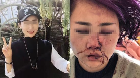 女子被打伤前后对比 图据人民网