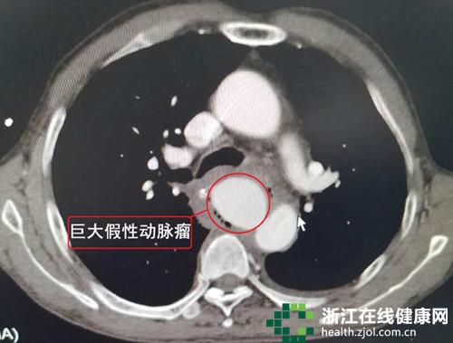 CT闪现的庞大假性动脉瘤