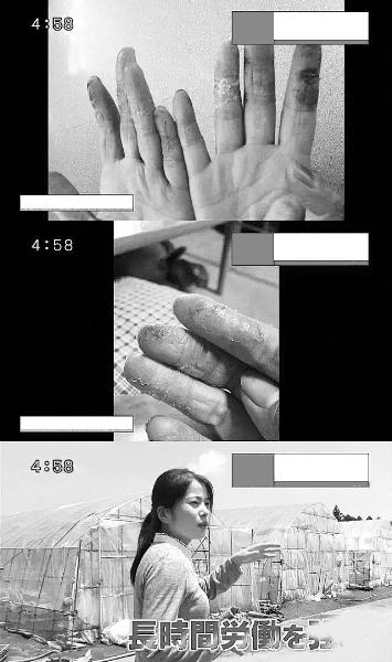 研修生在日本渔业、农业和建筑行业从事低薪、脏、累工作。图为研修生伤痕累累的手（视频截图）