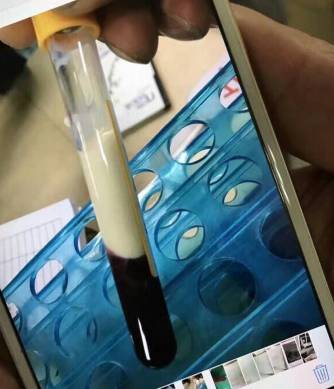 △ 小健抽出的血为红白混合物，沉淀后浮在上面的脂类物质占一半。