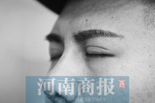 赵先生的双眼皮手术在眼皮上留下的这道疤痕半年多过去仍没恢复