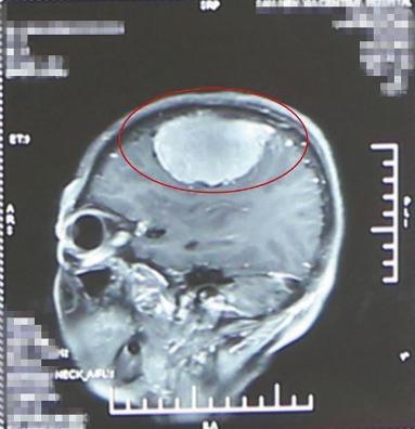 　　张大娘手术前头颅CT显示，脑子里发现拳头大的肿瘤。