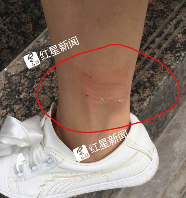 ▲被狗咬后的印痕 受访者供图