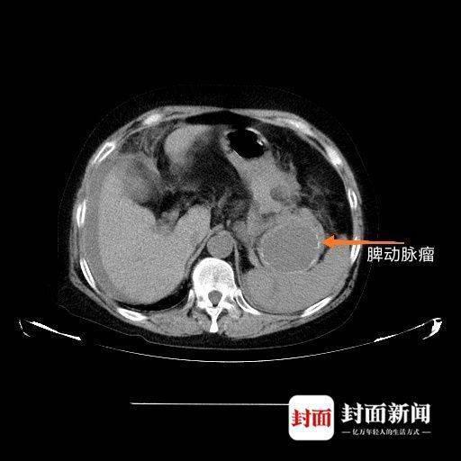 女子觉得肚里有水翻滚 实为腹腔大出血差点没命