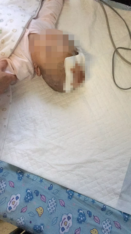 图说:刚结束第四次手术的凡凡。