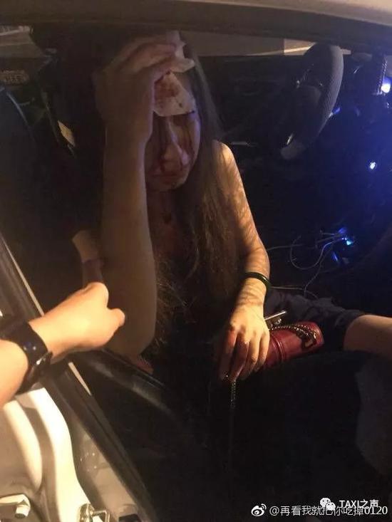 北京25岁女模坐滴滴惨被毁容 开车的是64岁男司机