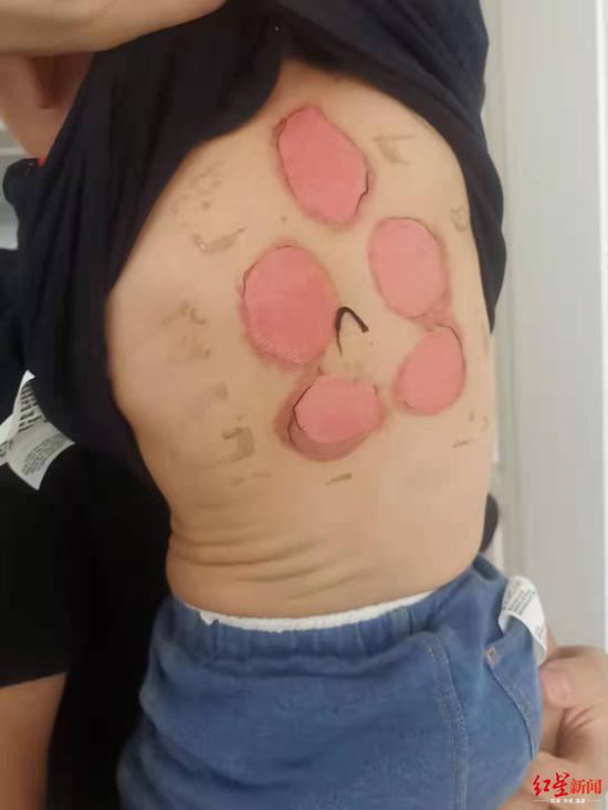 事发已4天,孩子背部灼伤处仍发红
