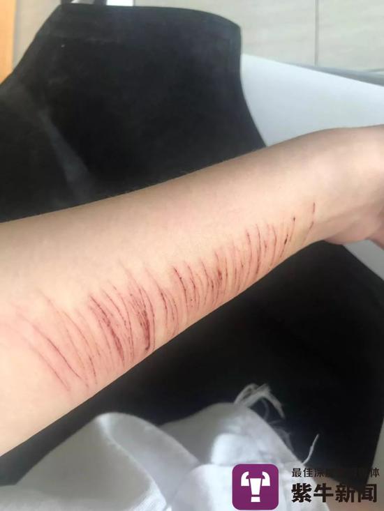 情感瓦解的小婷曾屡次自残