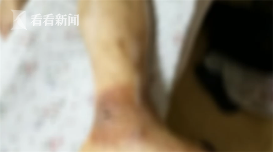 嗓子疼扎针放血是什么原理_嗓子疼中医扎针