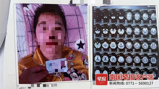 ▲術後,許女士構成二級傷殘。受訪者供圖