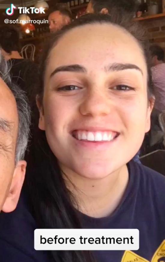 澳洲少女做下巴抽脂手术 拆线后新脸吓坏家人