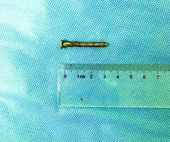 69天女婴腹中现一颗螺丝钉 疑是三岁姐姐喂服