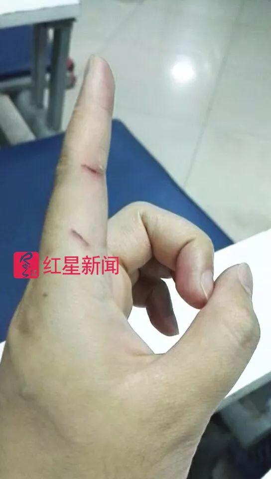 ▲7月5日晚，邓尔的左手手指被野猫抓出两道伤痕，他决定打狂犬病疫苗 受访者供图