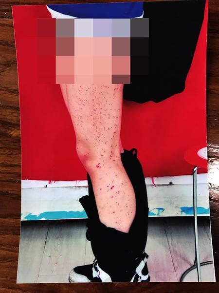 华商报:女生被同桌用笔扎得满腿是伤 校方：是开玩笑(图)