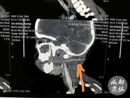 入喉10.5厘米  差点贯穿喉咙
