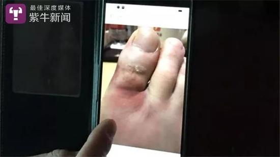 [颜程涛向扬子晚报紫牛记者展示了他受伤的右脚]