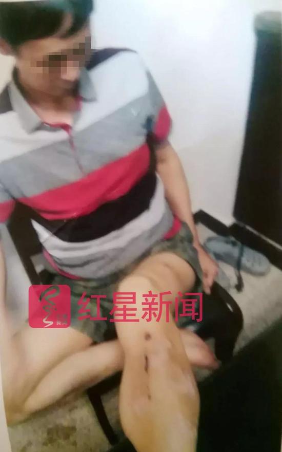 ▲林霞（化名）父亲被撞伤   受访者供图