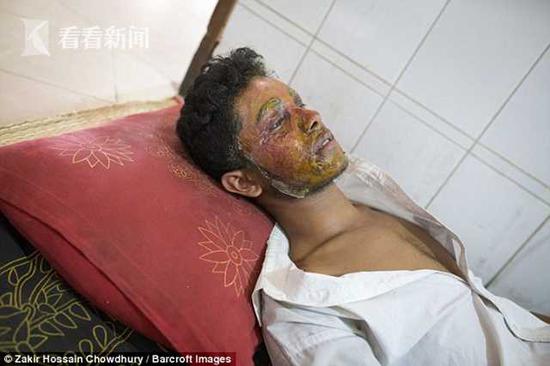 孟加拉国男子拒绝女子求爱遭泼硫酸 或终生留伤疤