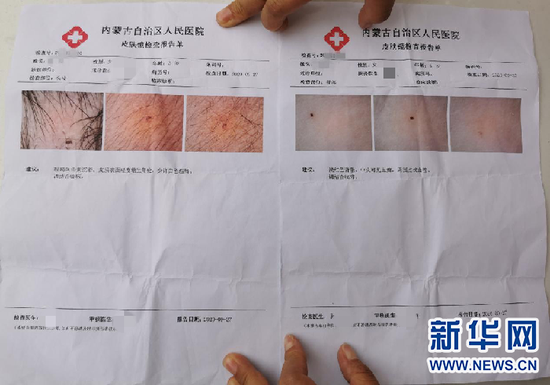 一名身上有不明針眼的孩子的檢查報告單上,可清晰看到針眼。新華網 楊騰格爾攝