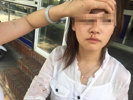 鹿女士嘴唇及眼底被打出血,脸上也有抓伤。当事人供图
