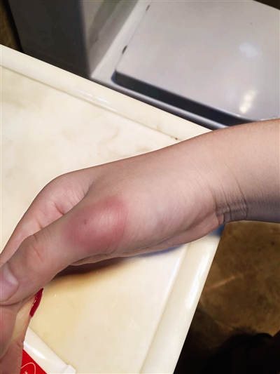 小江的手指、腿部都能看到明显伤痕。（家长供图）