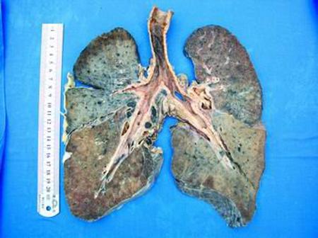 尘肺病。资料图