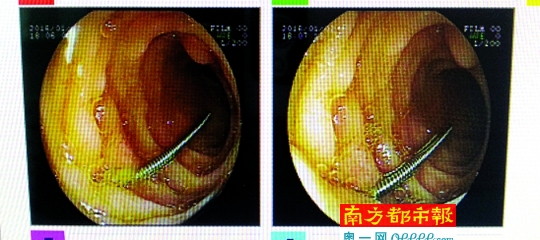 钢针一半已插入肠壁。 通讯员供图