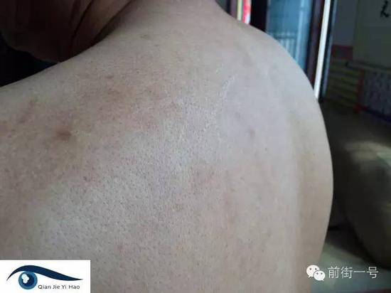 薛凤起后背的疤痕，他称这是被关期间遭公安用皮带、三角带抽打留下的疤痕证据。