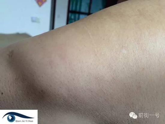 薛凤起左肩上部的疤痕，他称这是被关期间遭公安用皮带、三角带抽打留下的疤痕证据。