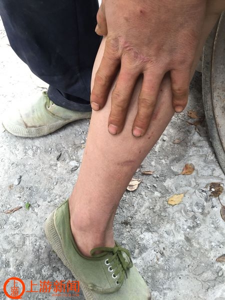 这是当年追着他的狼狗在他腿上留下的伤疤。上游新闻记者 张曼双 摄