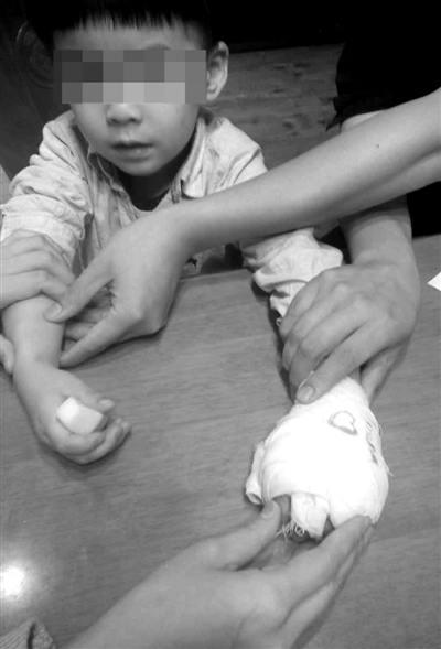 孩子受伤的手包着纱布。