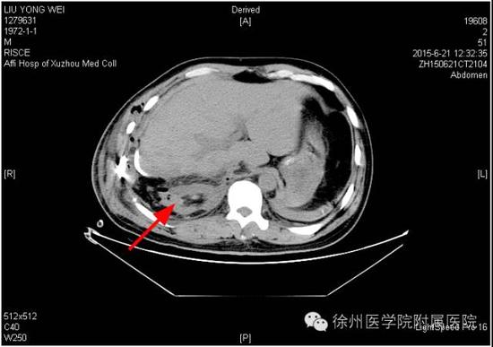 图一 2015年6月21日（术后第1天）CT，右肾如箭头所示。