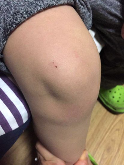 涉事幼儿膝盖上有疑似针孔状伤口  